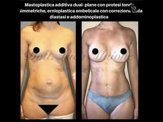 Mastoplastica additiva - Dott. Luca Maione