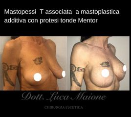 Mastopessi - Dott. Luca Maione