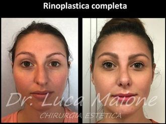Rinoplastica - 773989