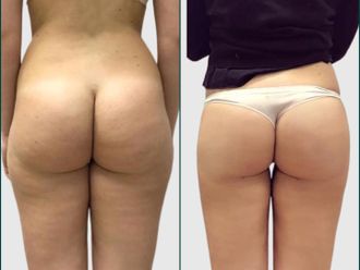 Liposcultura prima e dopo - 871466