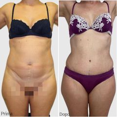 Dott. Luca Maione Addominoplastica