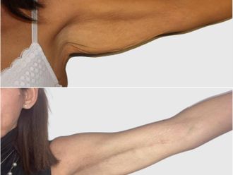 Liposcultura prima e dopo - 876191