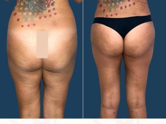 Liposcultura prima e dopo - 878987