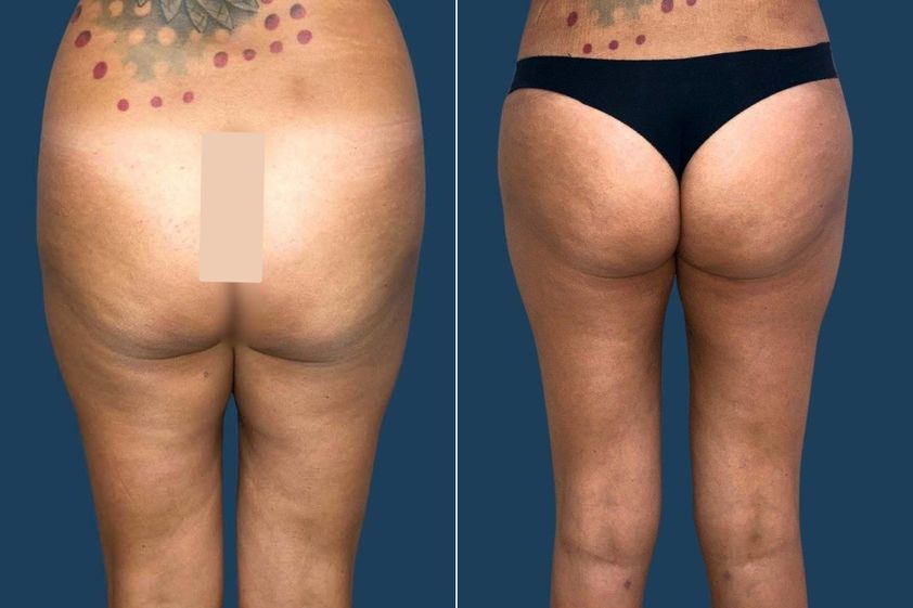 Liposcultura prima e dopo - 878987