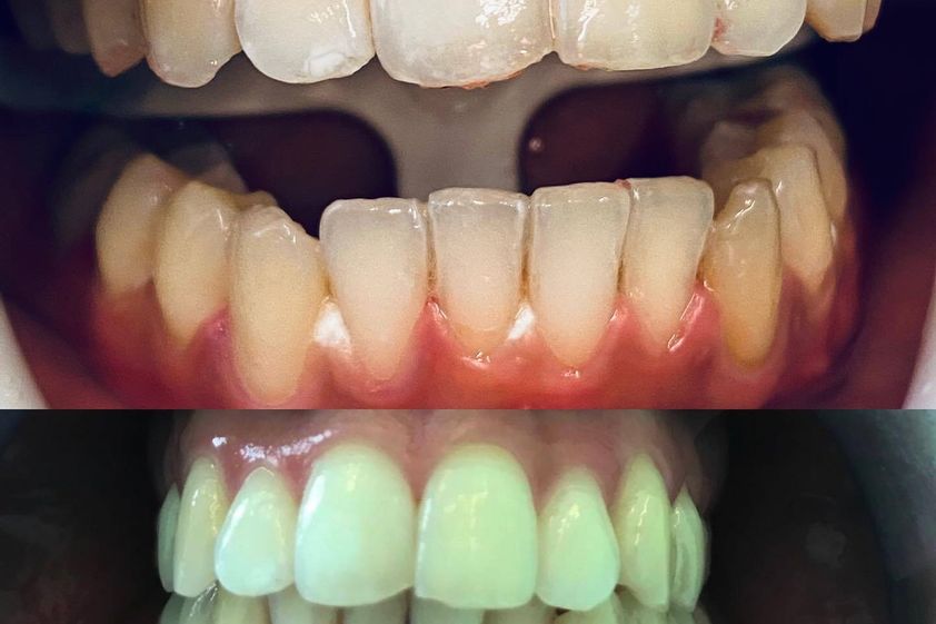 Sbiancamento denti prima e dopo - 856480