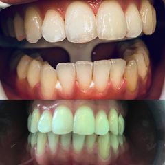 Sbiancamento denti - Dott. Fabio Vaja