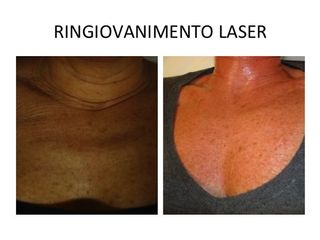 Laser prima dopo