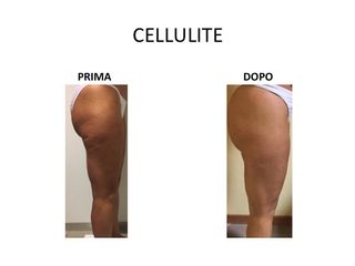 Cellulite prima dopo