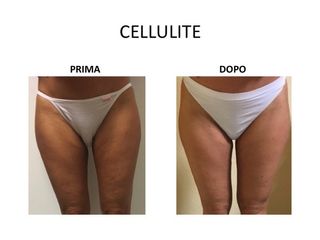 Cellulite prima dopo