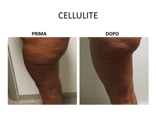 Cellulite prima dopo