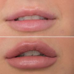Filler labbra - Dott. Riccardo Lucchesi