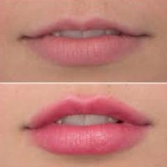 Filler labbra - Dott. Riccardo Lucchesi