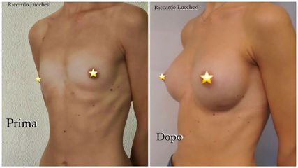 Mastoplastica additiva - Dott. Riccardo Lucchesi