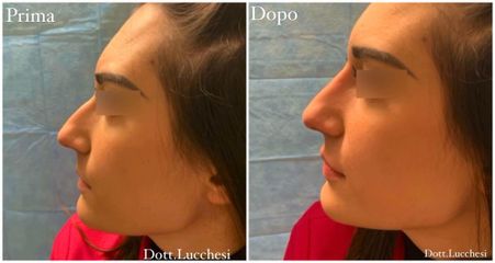 Rinofiller - Dott. Riccardo Lucchesi
