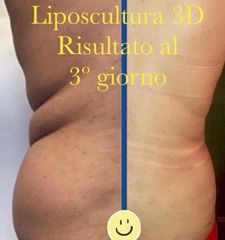 Liposcultura - Dott. Riccardo Lucchesi