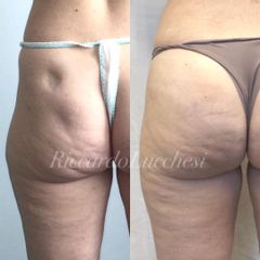 Filler glutei - Dott. Riccardo Lucchesi
