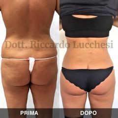 Liposuzione - Dott. Riccardo Lucchesi