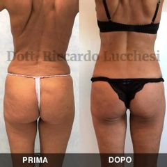 Liposuzione - Dott. Riccardo Lucchesi