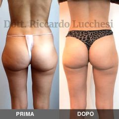 Liposuzione - Dott. Riccardo Lucchesi