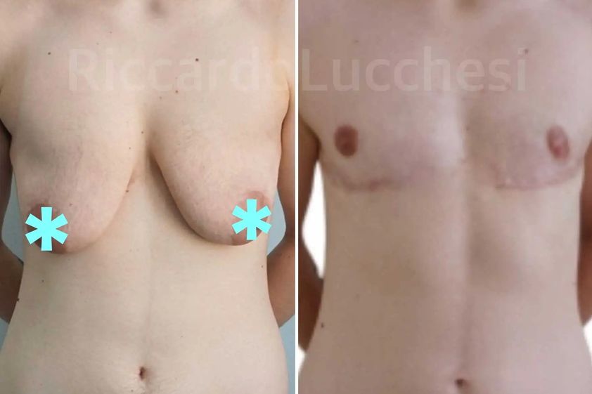 Cambio di sesso prima e dopo - 861731