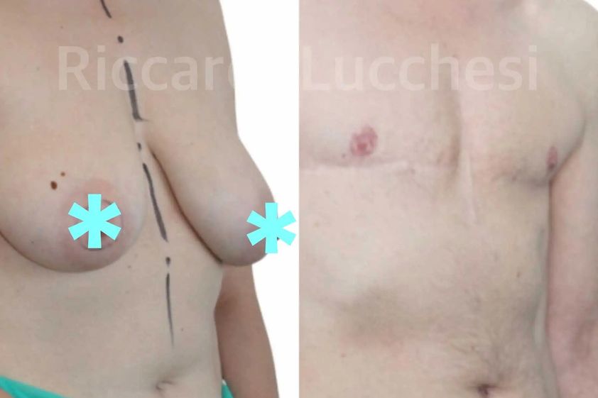 Cambio di sesso prima e dopo - 861732