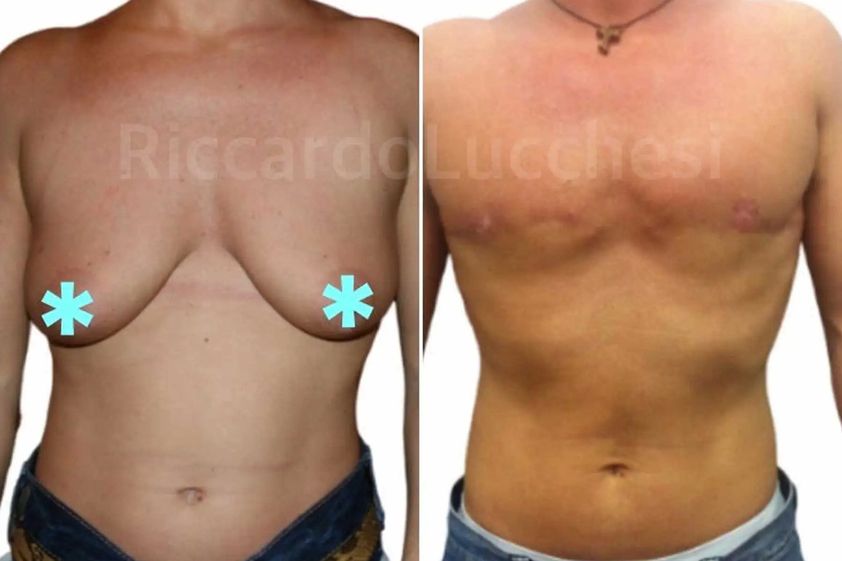 Cambio di sesso prima e dopo - 861734