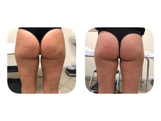 Cellulite prima e dopo