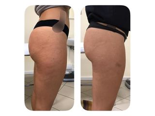 Cellulite prima e dopo