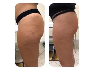 Cellulite prima e dopo
