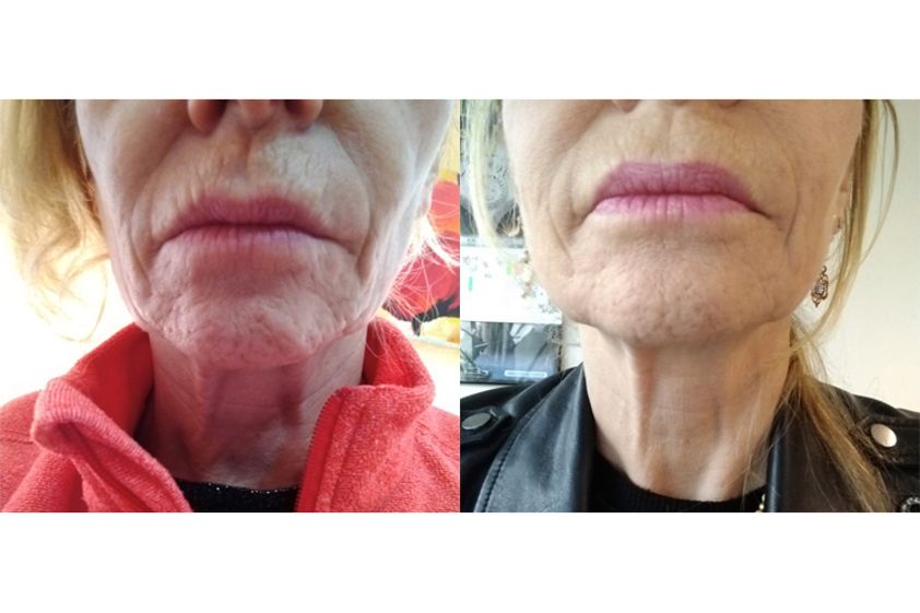 Rughe prima e dopo - 773061