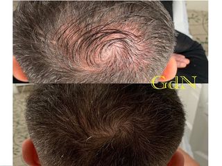 alopecia prima e dopo