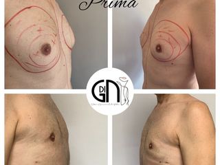 Ginecomastia prima e dopo