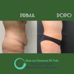 Addominoplastica - Dott.ssa Gianmarì Di Nola