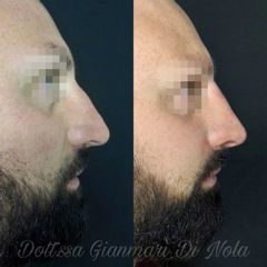 Rinofiller - Dott.ssa Gianmarì Di Nola