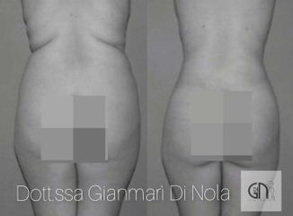 Liposuzione - Dott.ssa Gianmarì Di Nola