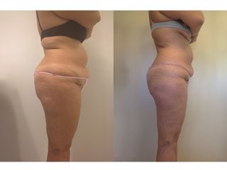 liposuzione prima dopo