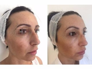 mesobotox prima dopo