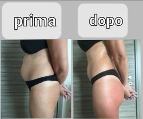 Carbossiterapia - SCEB - Medicina Estetica