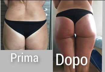 Carbossiterapia - SCEB - Medicina Estetica
