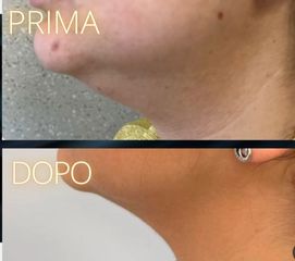 Ringiovanimento - SCEB - medicina estetica