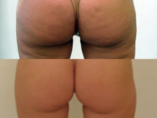 Cellulite prima e dopo