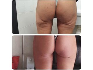 Gluteoplastica - Dottor Naser Jabbarpour esperto in medicina estetica e in tricologia