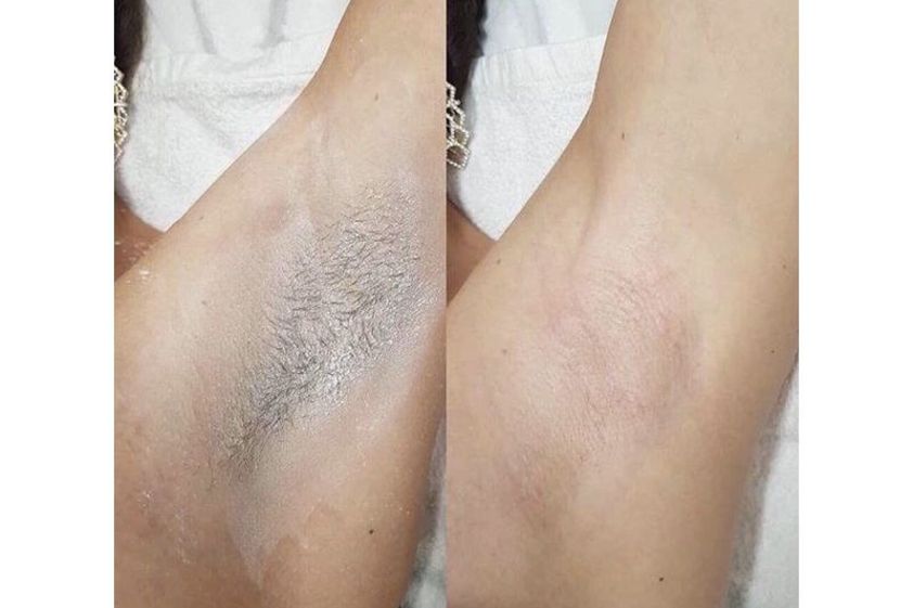 Depilazione laser prima e dopo - 813602