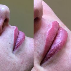 Filler labbra - Dott. Valerio Scarano Catanzaro