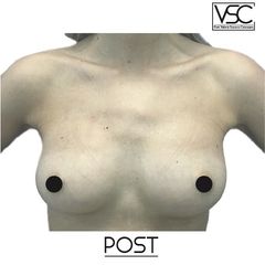 Mastoplastica additiva - Dott. Valerio Scarano Catanzaro