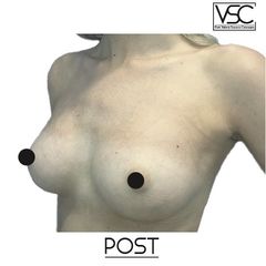 Mastoplastica additiva - Dott. Valerio Scarano Catanzaro