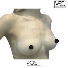 Mastoplastica additiva - Dott. Valerio Scarano Catanzaro