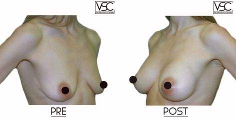 Mastoplastica additiva - Dott. Valerio Scarano Catanzaro