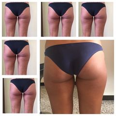 Cellulite - Dott. Valerio Scarano Catanzaro