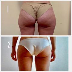Cellulite - Dott. Valerio Scarano Catanzaro